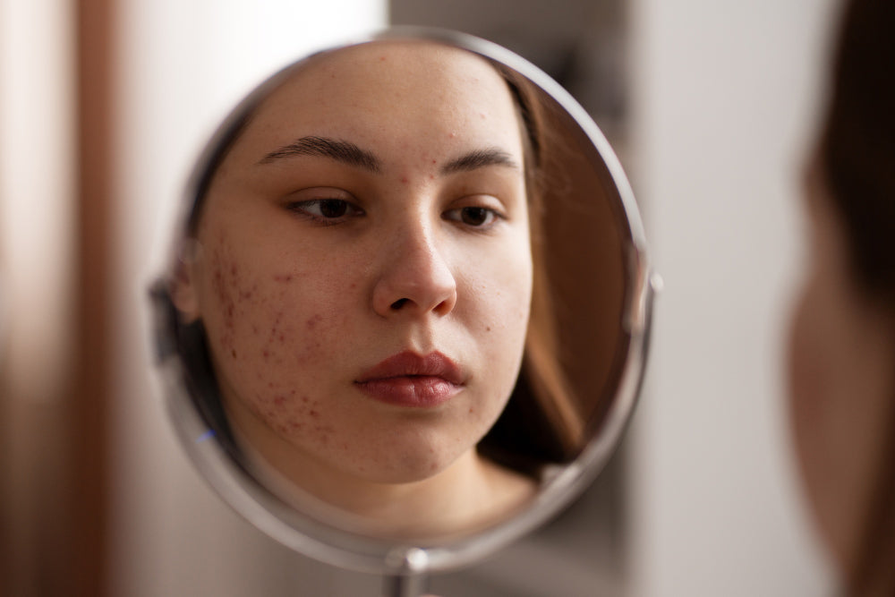 Salicylic Acid Image Skincare breakout