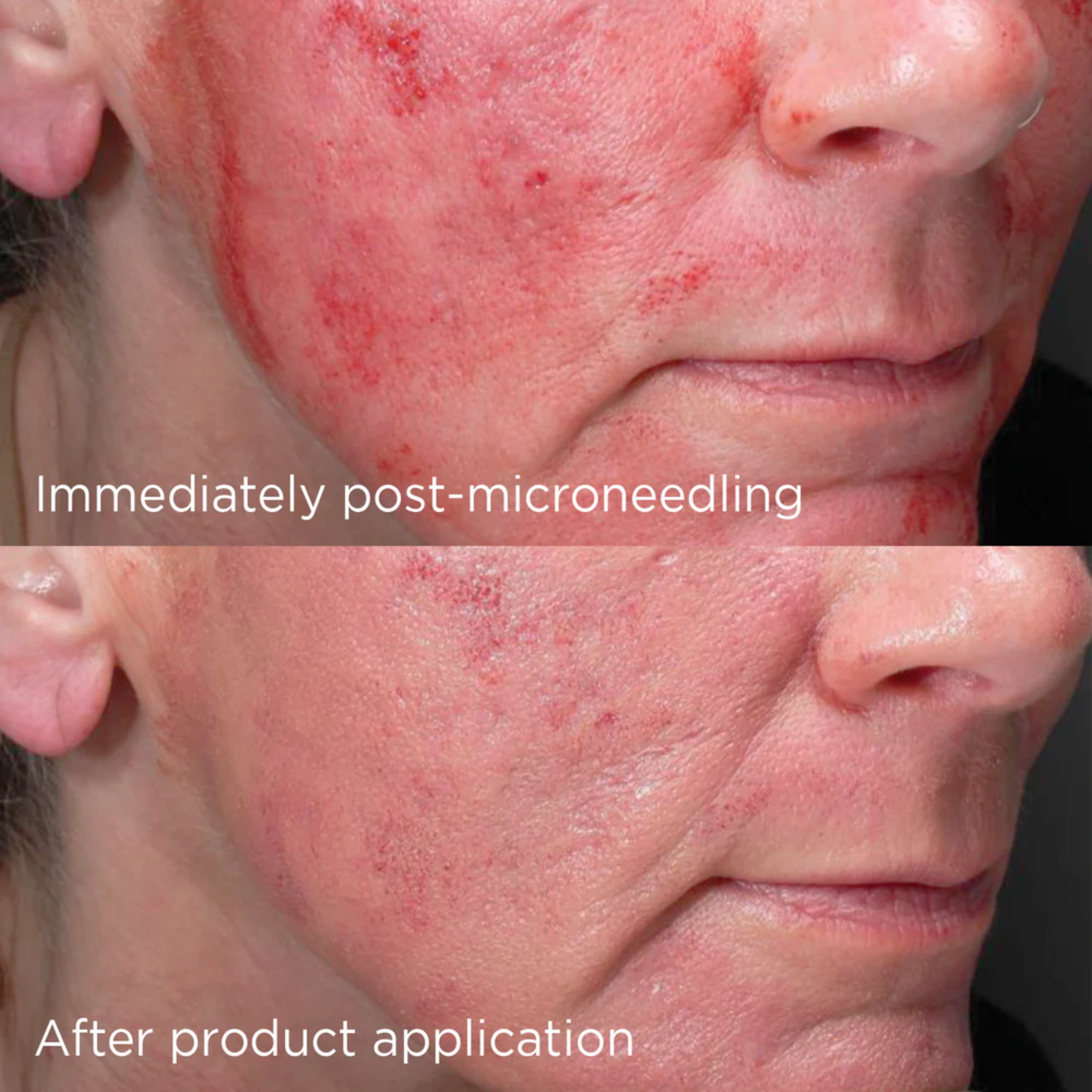 Before and after of using advanced smartblend mineral moisturiser spf50 post-microneedling